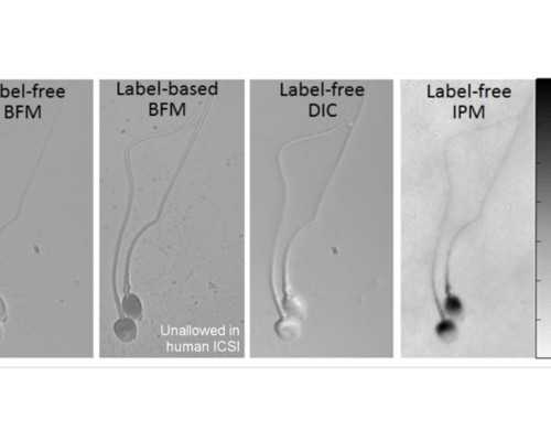 10号染色体q26缺失的原因?无创显示10号染色体q26缺失原因较多